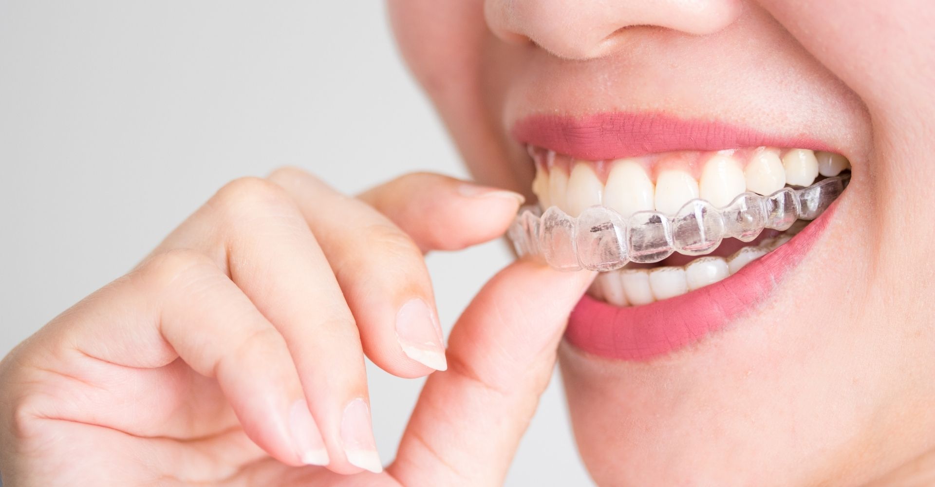 Straighten Up & Smile On: The Ultimate Guide to Braces vs